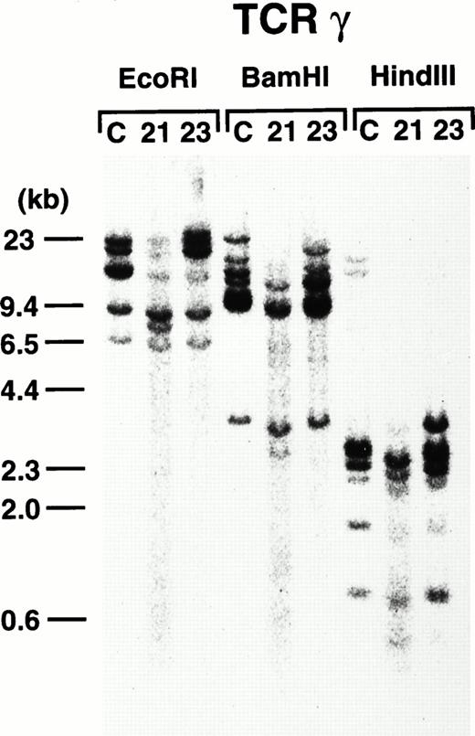 Fig. 8. TCR-γ rearrangement of the leukemic cells of 4-3 and 4-5. Rearranged bands are evident in both cases after each enzyme digestion. Molecular markers are shown on the left.