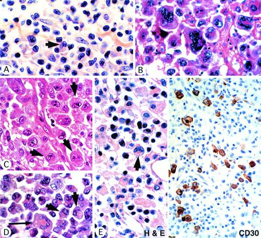 Fig. 1. ALK-positive ALCLs show a wide morphologic spectrum. (A) Small-cell pattern. A predominant population of small cells with irregular nuclei is associated with scattered large hallmark cells (arrow) showing eccentric lobated nuclei. (B) Giant-cell–rich pattern, showing striking cellular pleomorphism. (C) Common-type ALCL showing several hallmark cells (arrows). (D) Common-type ALCL showing several hallmark cells (arrow) and also a cell with crown-like nuclei (long arrow). (E) Lymphohistiocytic variant showing, in the hematoxylin and eosin-stained section, a single hallmark cell (arrow). Note the eosinophilic paranuclear area. Other cells are nonneoplastic, including histiocytes and plasma cells. Immunostaining of this case for CD30 highlights the scattered malignant cell population.