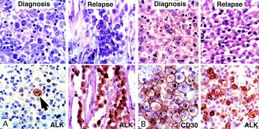 Fig. 2. Morphologic transformation in 2 relapsing cases. Giemsa (A) and hematoxylin and eosin (B) staining is shown above and immunostaining is shown below. (Case A) The morphologic appearance at diagnosis was that of a lymphohistiocytic variant with scattered large neoplastic cells. ALK staining confirmed the scarcity of malignant cells (arrow). A few months later, this patient developed lung involvement consisting exclusively of large cells. (Case B) In this case, the morphologic appearance at diagnosis was that of a common-type ALCL with many large cells containing eccentric nuclei. Lymph node biopsy at relapse showed the features of a small-cell variant. Scattered large cells were strongly positive for ALK1, whereas small cells showed only moderate/weak staining.