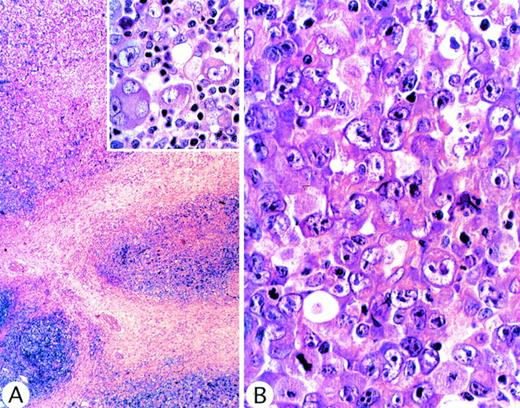 Fig. 3. ALCL of common type in which, at low power magnification, (A) sclerotic bands were evident, suggestive of nodular sclerosis Hodgkin's disease. (Inset) Malignant cells, showing Reed-Sternberg–like appearance. These morphologic features are consistent with Hodgkin's disease, but in other areas (B) the tumor showed the typical appearance of common-type ALCL.