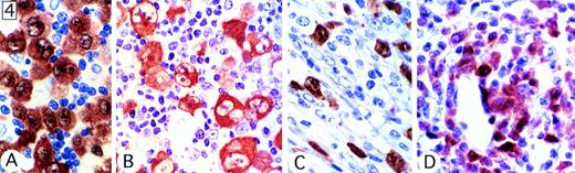 Fig. 4. Patterns of expression of ALK protein. (A) Both cytoplasmic and nuclear expression of the protein was seen in most tumors. (B) ALK staining was confined to the cytoplasm of neoplastic cells in a few cases. This case was of common type, but showed Hodgkin's-like areas. (C) Lymphohistiocytic variant showing scattered positive cells, some of them with a fibroblast-like appearance. (D) Small-cell variant, showing strong staining of large anaplastic cells, associated with only moderate/weak nuclear staining in the small cells.