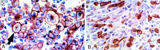 Fig. 5. Staining for CD30. (A) Characteristic pattern, as seen in virtually all cases, comprising membrane staining associated with a cytoplasmic dot in the Golgi area. (B) Spindle cells with a fibroblast-like appearance in a lymphohistiocytic case.