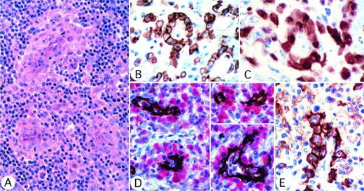 Fig. 6. Perivascular pattern of tumor cells infiltration. (A) Several tumor cell foci are seen, all localized around vessels (hematoxylin and eosin). (B through D) The perivascular pattern is highlighted by staining for CD30 (B) or ALK (C) or by double labeling for vessels, with anti-CD31 (brown) and for ALK protein (red). (E) In the small-cell variant case, CD30 is strongly expressed by large cells surrounding the vessel, whereas the small cell population is only weakly positive.