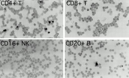 Fig. 1. Detection of EBER1 expression by in situ hybridization. Purified populations of CD4+ T cells, CD8+T cells, CD16+ NK cells, and CD20+ B cells obtained from patient 1, 19 months before the development of lymphoma, were cytocentrifuged and hybridized with an alkaline phosphatase-conjugated EBER1 antisense oligonucleotide probe.