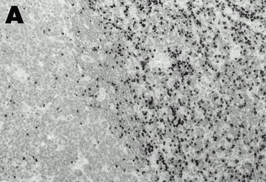 Fig. 2. Detection of EBER1 expression by in situ hybridization of lymphoma tissues. (A) Lymph node from case 1 (100X magnification); (B) spleen from case 2 (200X magnification).