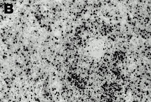 Fig. 2. Detection of EBER1 expression by in situ hybridization of lymphoma tissues. (A) Lymph node from case 1 (100X magnification); (B) spleen from case 2 (200X magnification).