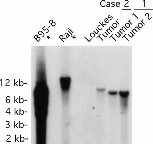 Fig. 3. EBV clonality in lymphoma tissues assessed by Southern analysis. Genomic DNA was digested with BamHI, separated on an agarose gel, and transferred to a nitrocellulose membrane. The membrane was hybridized with 32P-labeled B95-8 fragment containing the LMP open reading frame, washed, and visualized by autoradiography. Tumors 1 and 2 were derived from different lymph nodes of case 1; one tumor specimen was derived from case 2. B95-8 and Raji cell lines were used as EBV–positive controls; Louckes cell line was used as an EBV–negative control.