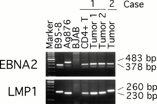 Fig. 5. EBV typing of virus-infected patient peripheral blood and lymphoma tissues. DNA, extracted from CD4+ peripheral blood T cells and lymphoma specimens (from distinct lymph nodes) of patient 1, from a lymphoma specimen (spleen) of patient 2, and from control cell lines, was subjected to PCR amplification with specific probes. The EBNA-2 primers were designed to distinguish type-1 and type-2 EBV; the LMP primers were designed to distinguish full length from deleted LMP-1 gene.