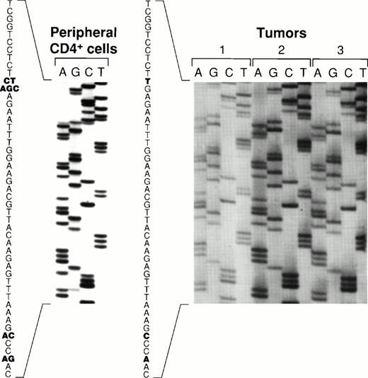 Fig. 6. Comparative sequence analysis of EBNA-1 from peripheral blood CD4+ T cells and lymphoma specimens. An EBNA-1 carboxy terminal fragment comprising nucleotides 1341-1671 (330 bp fragment) was PCR-amplified with DNA extracted from peripheral blood CD4+ T cells from patient 1, from two lymphoma specimens from patient 1 (distinct lymph nodes tumors 1, and 2), and from a lymphoma specimen from patient 2 (spleen, tumor 3). Shown are the results of direct sequencing of EBNA-1 codons 475 to 490. Nucleotide substitutions compared to the prototype EBNA-1(B95-8) are highlighted in bold. Multiple substitutions at the same position are indicative of multiple EBNA-1 variants.