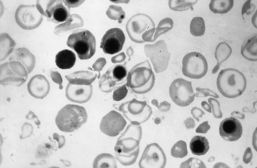 Fig. 3. Peripheral blood smear of the newborn shown in Fig 4. Note the hypochromia, anisopoikilocytic changes, and erythroblastosis.