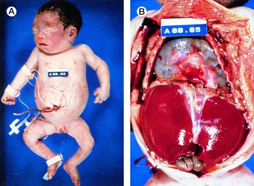 Fig. 4. Autopsy photographs of a newborn with hemoglobin Bart's hydrops fetalis syndrome, delivered by caesarean section at 31 week of gestation.59 Despite active resuscitation, the infant died within an hour after birth. Note edema of face and abdominal distension (A). The thoracic cavity is filled by the pericardial sac distended by effusion and cardiomegaly; there is massive hepatomegaly (B). Pictures courtesy of Prof H.A. Heggtveit.