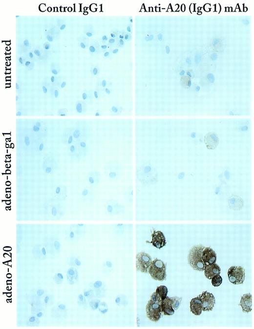 Fig. 1. Adenoviral-mediated gene transfer of A20 achieves high levels of expression in cultured PAEC. Cultured 90% to 100% confluent PAEC, from the fifth or the sixth passage, were either not infected (untreated) or infected with either the control rAd.β-gal (adeno-beta-gal) or rAd.A20 (adeno A20). Forty-eight hours following transduction, PAEC were recovered and cytospinned on glass slides using a cytospin 3 apparatus (Shandon Inc, Pittsburgh, PA) before being assessed by immunohistochemistry for the expression of the A20 transgene. Immunohistochemical analysis was performed using a mouse anti-human A20 MoAb of the IgG1 isotype, followed by a secondary peroxidase-conjugated goat anti-mouse antibody (Dako, Carpinteria, CA; right panel). A nonrelevant mouse MoAb was used as a control (left panel). Results show low to undetectable levels of A20 in noninfected or rAd.β-gal–infected PAEC. In contrast PAEC transduced with the rAd.A20 showed high levels of expression of A20 in >95% of the cells. Expression of the A20 protein was limited to the cytoplasm.