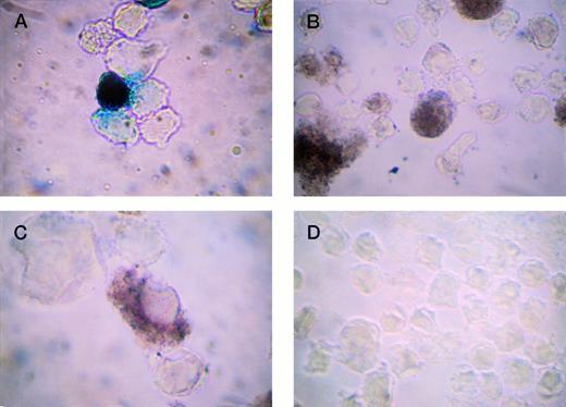 Fig. 3. Detection of β-gal expression in TPA-stimulated HEL cells. LacZ was driven by cytomegalovirus (CMV) (A and B) or −245 bp hPF4 promoters (C and D). (A) X-gal staining (positive cells blue); (B) IGSS staining (positive cells brown); (C) IGSS staining; and (D) negative control, IGSS with no primary antibody (no brown signal). Original magnification × 500.