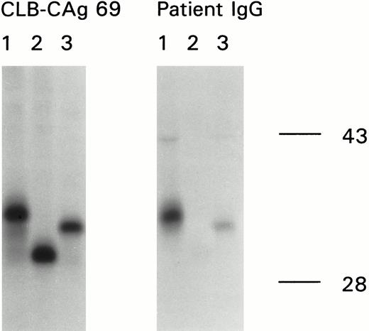 Fig. 3. Epitope mapping of antibodies present in the inhibitor plasma by immunoprecipitation. (A) Structure of the factor VIII light chain and the carboxyterminal truncated polypeptides synthesized in vitro and used for immunoprecipitation. The bar at the top of the figure represents the domain structure of the factor VIII light chain with the neighboring B domain. The amino acid residue numbers below the bar indicate the boundaries between the domains. The epitope for MoAb CLB-CAg 69, consisting of the amino acid residues Lys1673-Arg1689 within the amino-terminal region of the A3 domain (22), is indicated by a black bar. The three lines at the bottom of the figure represent three carboxyterminal truncated polypeptides. 1, Asp1563-Asp1840; 2, Asp1563-Gln1778; 3, Asp1563-Met1823. (B) Reactivity of MoAb CLB-CAg 69 (left) and patient's plasma (right) with truncated recombinant fragments of the A3 domain of factor VIII. Binding of anti-factor VIII antibodies to the metabolically labeled factor VIII fragments was assessed by immunoprecipitation and analyzed under reducing conditions on a 10% (wt/vol) SDS-polyacrylamide gel. Lane 1, Asp1563-Asp1840; lane 2, Asp1563-Gln1778; lane 3, Asp1563-Met1823.