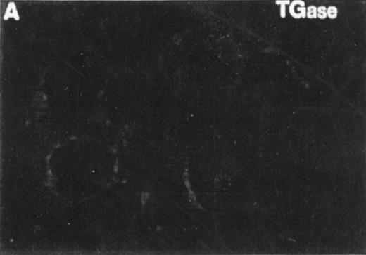 Fig. 7. Correlation between the induction of TGase II protein and apoptosis in RPMI 8226 cells. Cells were incubated for 6 days in the absence of retinoids (A) or in the presence of 10−7 mol/LatRA (B) or the combination of both 10−7 mol/L CD367 and 10−7 mol/L CD2425 (C). TGase II protein expression was detected by indirect immunofluorescence using a monoclonal anti-TGase II antibody (left panel), and apoptotic cells were detected after MGG coloration on cytospin preparations (right panel).