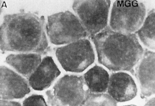 Fig. 7. Correlation between the induction of TGase II protein and apoptosis in RPMI 8226 cells. Cells were incubated for 6 days in the absence of retinoids (A) or in the presence of 10−7 mol/LatRA (B) or the combination of both 10−7 mol/L CD367 and 10−7 mol/L CD2425 (C). TGase II protein expression was detected by indirect immunofluorescence using a monoclonal anti-TGase II antibody (left panel), and apoptotic cells were detected after MGG coloration on cytospin preparations (right panel).