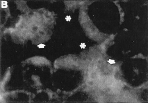 Fig. 7. Correlation between the induction of TGase II protein and apoptosis in RPMI 8226 cells. Cells were incubated for 6 days in the absence of retinoids (A) or in the presence of 10−7 mol/LatRA (B) or the combination of both 10−7 mol/L CD367 and 10−7 mol/L CD2425 (C). TGase II protein expression was detected by indirect immunofluorescence using a monoclonal anti-TGase II antibody (left panel), and apoptotic cells were detected after MGG coloration on cytospin preparations (right panel).