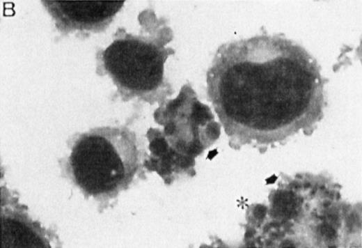Fig. 7. Correlation between the induction of TGase II protein and apoptosis in RPMI 8226 cells. Cells were incubated for 6 days in the absence of retinoids (A) or in the presence of 10−7 mol/LatRA (B) or the combination of both 10−7 mol/L CD367 and 10−7 mol/L CD2425 (C). TGase II protein expression was detected by indirect immunofluorescence using a monoclonal anti-TGase II antibody (left panel), and apoptotic cells were detected after MGG coloration on cytospin preparations (right panel).