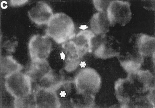 Fig. 7. Correlation between the induction of TGase II protein and apoptosis in RPMI 8226 cells. Cells were incubated for 6 days in the absence of retinoids (A) or in the presence of 10−7 mol/LatRA (B) or the combination of both 10−7 mol/L CD367 and 10−7 mol/L CD2425 (C). TGase II protein expression was detected by indirect immunofluorescence using a monoclonal anti-TGase II antibody (left panel), and apoptotic cells were detected after MGG coloration on cytospin preparations (right panel).
