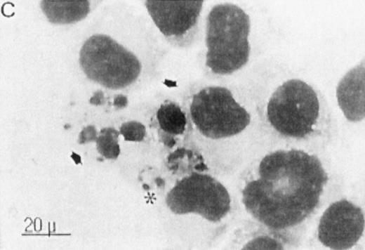 Fig. 7. Correlation between the induction of TGase II protein and apoptosis in RPMI 8226 cells. Cells were incubated for 6 days in the absence of retinoids (A) or in the presence of 10−7 mol/LatRA (B) or the combination of both 10−7 mol/L CD367 and 10−7 mol/L CD2425 (C). TGase II protein expression was detected by indirect immunofluorescence using a monoclonal anti-TGase II antibody (left panel), and apoptotic cells were detected after MGG coloration on cytospin preparations (right panel).