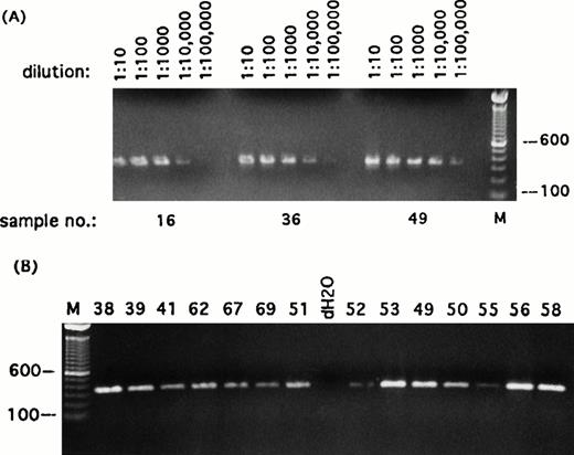 Fig. 1. Detection of transcripts for β-actin in single Reed-Sternberg cells and their variants. Representative sampling of PCR results using primers specific for β-actin transcript. (A) Three randomly selected reamplified samples were titrated out to 1 : 100,000 dilution. (B) Each of the 49 reamplified single cell cDNA libraries was then diluted to 1 : 5,000 and screened for expression of β-actin. All single-cell libraries included in this study expressed β-actin titratable to at least 1 : 5,000. PCR products were run on ethidium bromide-stained 1% agarose gels. Positive or negative results were scored on the basis of intensity of ethidium bromide staining. Sample numbers correspond to cell numbers listed in Table 1. Molecular-weight markers (M) are labeled in base pairs.