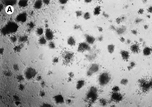 Fig. 4. Lymphoma colonies formed by the BC-1 cells treated with either sense or antisense IL-6 oligonucleotides. Cells were plated at 5,000 cells/mL and cultured for 14 days with either IL-6 sense (10 μmol/L) (A) or IL-6 antisense oligonucleotides (10 μmol/L) (B). Colony formation was almost completely inhibited in cultures containing IL-6 antisense oligonucleotides.