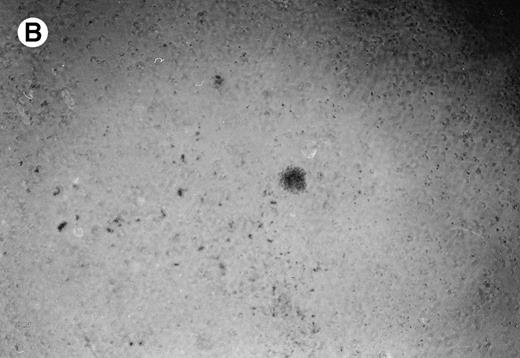 Fig. 4. Lymphoma colonies formed by the BC-1 cells treated with either sense or antisense IL-6 oligonucleotides. Cells were plated at 5,000 cells/mL and cultured for 14 days with either IL-6 sense (10 μmol/L) (A) or IL-6 antisense oligonucleotides (10 μmol/L) (B). Colony formation was almost completely inhibited in cultures containing IL-6 antisense oligonucleotides.