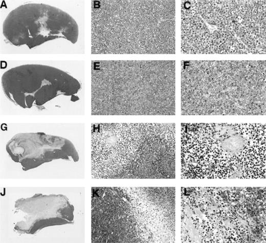 Fig. 4. Gross and microscopic morphology of LMP1-expressing and nonexpressing BL tumors. Female BALB/c nu/nu mice were injected subcutaneously with 1 × 107 cells from exponentially growing BL41 EBV− cell line (A, B, and C); EBV-P3HR-1–converted BL41 cell line (D, E, and F); EBV-B95-8–converted BL41 cell line (G, H, and I); or LMP1-transfected (J, K, and L) BL41 cell line. Tumors were removed in toto 8 to 14 weeks after the initial inoculation and processed for histology. (A, D, G, and J) Gross morphology of Burkitt's tumors removed in toto with abstract epidermis and dermis showing in (A) and (D) mostly viable-looking tumor tissue with small areas of central necrosis, and in (G) and (J) tumors with extensive necrosis and little viable tumor (no magnification). (B, E, H, and K) Microscopic morphology (original magnification × 10) of Burkitt's tumors showing in (B) and (E) viable-looking tumor tissue, and in (H) and (I) the abrupt interface between necrotic and viable tumor tissue. (C, F, I, and L) Higher power magnification (original magnification × 40) of viable tumor tissue with patent capillaries containing red blood cells (C) and (F), and capillaries occluded with thrombi at various stages of organization (I and L).