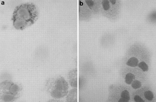 Fig. 1. Photomicrograph of a human eosinophil detected in a buffy coat cytospin. (a) The eosinophil was stained specifically with mouse monoclonal anti–human IL-6 using the APAAP technique, showing a granular pattern of immunoreactivity as compared with the negative isotype control (b) (original magnification ×100).