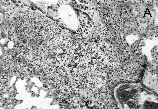 Fig. 3. (A) Micrograph of lung tissue 72 hours after intranasal infection with 1 × 103 CFU of K pneumoniae B5055. Lung abscess with severe tissue destruction in a PBS-treated control animal. Hematoxylin & Eosin (H&E); original magnification ×150. (B) Small foci of hepatic necrosis. H&E; original magnification ×600.