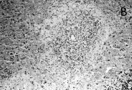 Fig. 4. (A) Micrograph of lung tissue 48 hours after intranasal infection with 1 × 103 CFU of K pneumoniae B5055 and pretreatment with G-CSF (50 μg/kg sc) at −48 hours, −36 hours, −24 hours, and −12 hours before infection. Peribronchiolar neutrophils without destruction of lung parenchyma. H&E; original magnification ×150. (B) Splenic abscesses in the red pulp containing numerous gram-negative bacilli are found. H&E; original magnification ×370. (C) Confluent hepatic necroses. H&E; original magnification ×150.