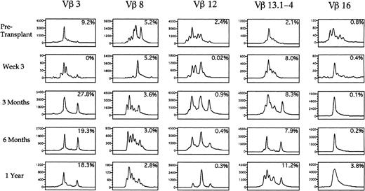 Fig. 9. Spectratypes of the T-cell repertoire during the first year after autologous transplantation with FACS-purified CD34+ HPC. PBLs were analyzed using CDR3 spectratyping and multiparameter flow cytometry to ascertain the Vβ TcR repertoire from an individual patient at the time points shown. Histograms of the relative sizes of the PCR-amplified CDR3 region for five representative Vβ TcR gene products are shown. Numbers in the upper right corner of each box represent the percentage of cells expressing a specific Vβ TcR. The scale of the y-axis varies in each small box according to the maximal peak amplitude, which is proportional to the quantity of RNA bearing the specific Vβ TcR. The x-axis represents the nucleotide length of the PCR-amplified TcR gene products.