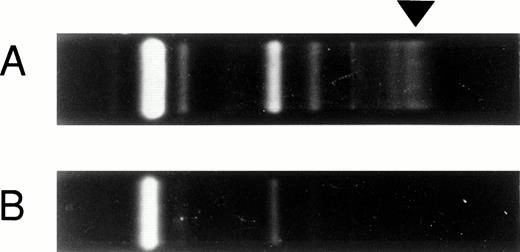 Fig. 1. Positive oligoclonal bands (arrow) on day 72 (A) and the disappearance of the bands after the two courses of corticosteroid therapy on day 91 (B).