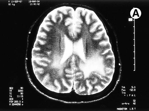 Fig. 1. Paths of blight signal on T2-weighted MRI in white matter of brain adjacent bilateral posterior lateral ventricles. (A) On day 526 when we just withheld cyclosporine. (B) On day 698 when chronic GVHD resolved by readministration of cyclosporine.