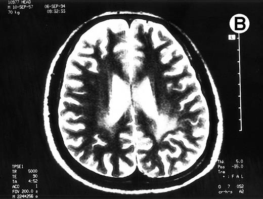 Fig. 1. Paths of blight signal on T2-weighted MRI in white matter of brain adjacent bilateral posterior lateral ventricles. (A) On day 526 when we just withheld cyclosporine. (B) On day 698 when chronic GVHD resolved by readministration of cyclosporine.