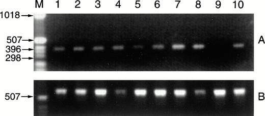 Fig. 4. CD40L message is detected in RNAs prepared from CLL samples. Fresh CLL B cells (1 × 107) purified from the peripheral blood of 2 patients were exposed overnight in culture to media alone, to SAC and IL-2 (1:60,000 and 40 U/mL), to PMA and ionomycin (10 ng/mL and 1.25 μg/mL), or to IL-4 (10 ng/mL). After 18 hours, RNAs were isolated, cDNAs were prepared by reverse transcriptase, and CD40L sequences were amplified (A). The RNAs analyzed are as follows: lane 1, CLL case no. 15 B cells with media; lane 2, with IL-2 and SAC; lane 3, with PMA and ionomycin; lane 4, with IL-4; lane 5, CLL case no. 16 B cells with media; lane 6, with IL-2 and SAC; lane 7, with PMA and ionomycin; lane 8, with IL-4. Positive and negative controls for detection of CD40L RNA sequences included RNAs from 1 × 107 D1.1 cells (lane 10, Jurkat mutants that constitutively express CD40L) and Ramos Burkitt's lymphoma B cells (lane 9, these do not express CD40L). The cDNA preparations were evaluated by amplification of GAPDH sequences (B).