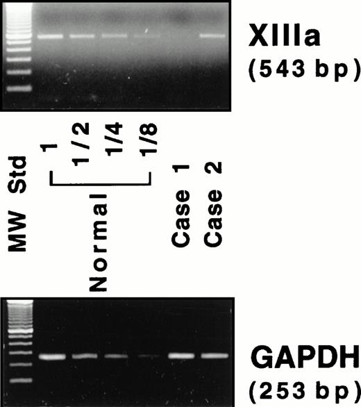Fig. 4. RT-PCR assay for the mRNAs of the A subunit (XIIIa) and GAPDH. Four lanes (normal) on the left of the panel contain amplified products of diluted (1 to 1/8) samples from a normal individual.