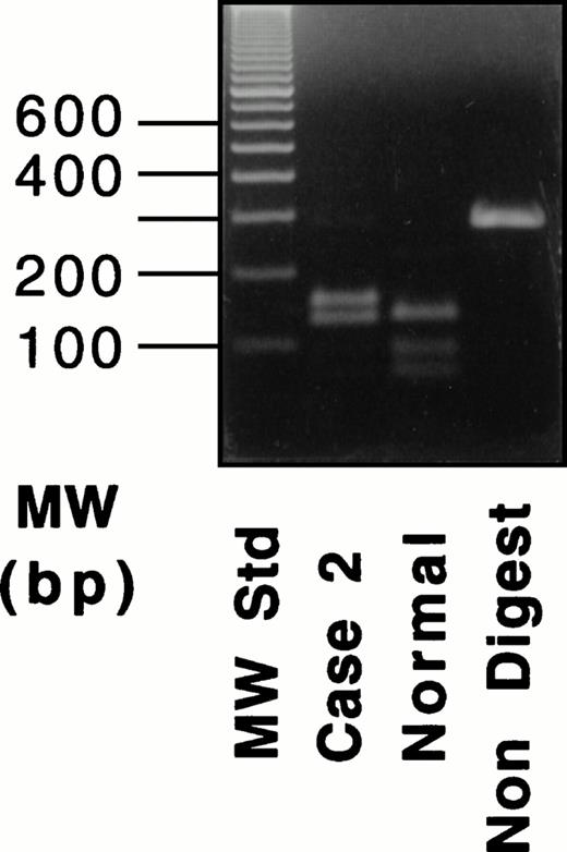 Fig. 5. RT-PCR and RFLP of a fragment containing exons XI-XIII for the Gly562-Arg mutation in case no. 2. An RT-PCR product was digested with Hpa II. For the results shown here, amplification was performed for 35 cycles.