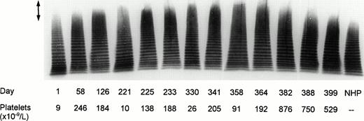 Fig. 3. Multimeric analysis of plasma vWF in SDS-1% agarose gel. Equal amounts of vWF (0.0025 U vWF:Ag) from plasma samples of the patient and from NHP were applied on top of the gel. Days of plasma collection and the platelet counts on the respective days are shown beneath the immunoblot of the electrophoretic gel. The arrow (↕) denotes the unusually large vWF multimers.
