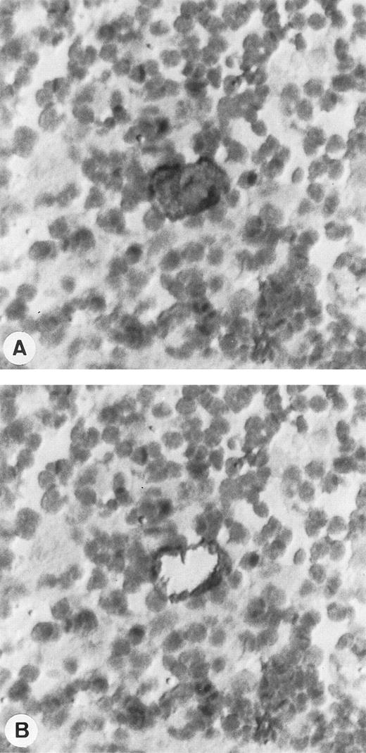 Fig. 1. Single-cell isolation of one HRS cell from a frozen section of a lymph node involved by HD and immunostained with CD30/HSR4 MoAb. (A) Tissue section before single-cell picking: HRS cell is strongly positive with the anti-CD30 antibody, whereas the surrounding lymphocytes are negative. (B) Tissue section after the micromanipulation of the nucleus of HRS cell (APAAP technique with nuclear counterstaining; original magnification × 400).