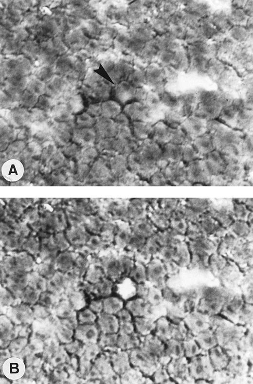Fig. 2. Single-cell isolation of one OCI LY8 cell from a frozen section of OCI LY8 tumor generated into nude mice and immunostained with CD20/L26 MoAb. Tissue section before (A) and after a single-cell sampling by micromanipulation (arrow; APAAP technique with nuclear counterstaining; original magnification × 400).