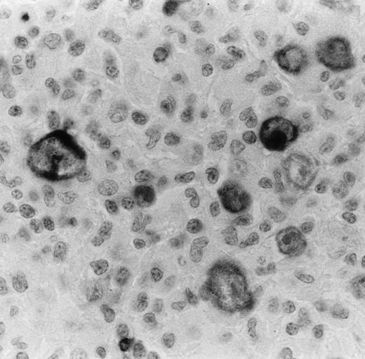 Fig. 3. Bcl-2 onco-protein expression in HRS in a case of nodular sclerosis HD as detected by anti–bcl-2 MoAb on paraffin section. Virtually all HRS cells are immunostained with this antibody. The staining is mainly cytoplasmic and finely granular. Bcl-2–positive small lymphocytes are also seen and used as an inner control of the immunostaining (immunoperoxidase technique with nuclear counterstaining; original magnification × 400).