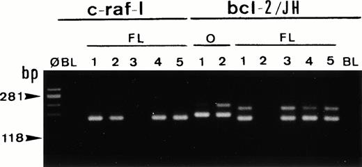 Fig. 7. Single-cell PCR analysis of the housekeeping genec-raf-1 and the bcl-2/JH rearrangement by seminested PCR analysis of cells isolated from frozen sections of a case of t(14;18)/MBR-positive follicular lymphoma (FL). The amplified DNA was separated on 2% agarose/NuSieve gel electrophoresis and visualized by staining with ethidium bromide. Ø, molecular weight markers; BL (blank), PCR amplification without DNA template to rule out contamination; O, single-cell positive control: t(14;18)/MBR-positive OCI LY8 tumor (lanes O, bcl-2/JH: 1 and 2). Single-cell DNA has been successfully amplified using c-Raf-1 primers (lanes FL: c-raf-1: 1 through 5): 4 positive cells (lanes 1, 2, 4, and 5) and bcl-2/JH primers (lanes FL, bcl-2/JH: 1 through 5): 4 positive cells (lanes 1 and 3 through 5). As expected, the amplification of the c-Raf-1 gene shows a band of 180 bp and the amplification of the t(14;18)/MBR shows a rearranged bcl-2/JH band within the expected range of size (110 to 360 bp).