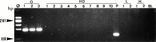 Fig. 8. Single-cell PCR analysis of the t(14;18)-MBR translocation by seminested PCR analysis of isolated OCI LY8 tumor cells (lane O: 1 through 3), HRS cells from a lymph node involved by HD (lanes HD: 1 through 10), small lymphocytes from the same lymph node (lanes L: 1 and 2), and t(14;18)-negative HSB-2 tumor cells (lanes H: 1 and 2). The amplified DNA was separated on 2% agarose/NuSieve gel electrophoresis and visualized by staining with ethidium bromide. Ø, molecular weight markers; BL (blank), PCR amplification without DNA template to rule out contamination; P, total DNA extracted from the same lymph node involved by HD. Only OCI LY8 tumor cells show rearranged bcl-2/JH bands within the expected range of size (110 to 360 bp; lanes O: 1 through 3). All single HD cells are negative for this translocation, whereas total DNA extracted from the same patient (P) is positive.