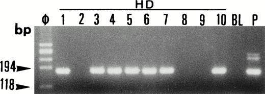 Fig. 9. Single-cell PCR analysis of the housekeeping genec-raf-1 by seminested PCR analysis of HRS cells from lymph node involved by HD (lanes HD: 1 through 10). The amplified DNA was separated on 2% agarose/NuSieve gel electrophoresis and visualized by staining with ethidium bromide. Ø, molecular size markers; BL (blank), PCR amplification without DNA template to rule out contamination; P, total DNA extracted from the same lymph node involved by HD. C-raf-1 has been successfully amplified from 7 of 10 isolated single cells as demonstrated by the presence of a band of 180 bp in 7 of 10 micromanipulated single-cell DNA. This indicates the validity of our methodology for the single-cell isolation and the PCR amplification of the extracted DNA from the majority of HRS cells isolated from tissue sections of lymph node involved by HD.