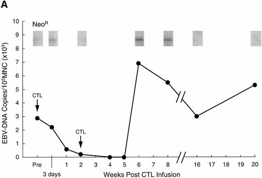 Fig. 3. Analysis of PBMC for evidence of the neo marker and for EBV DNA. (A) Levels of neo DNA are shown in the upper portion. They were measured by semiquantitative PCR analysis of 1 μg total DNA at various time points after the second CTL infusion. Lower portion shows EBV DNA in PBMC for the corresponding time points. Levels of EBNA 2 DNA were measured by nested semiquantitative PCR analysis of 1 μg total DNA. (B) Detection of marker gene in pleural fluid of patient no. 13, 3 weeks after CTL infusion. Detection in the infused CTL line and blood obtained on the same day are shown for comparison.