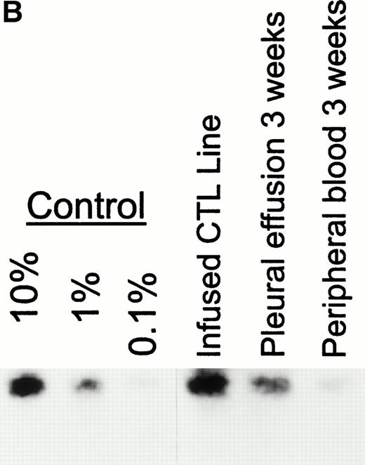 Fig. 3. Analysis of PBMC for evidence of the neo marker and for EBV DNA. (A) Levels of neo DNA are shown in the upper portion. They were measured by semiquantitative PCR analysis of 1 μg total DNA at various time points after the second CTL infusion. Lower portion shows EBV DNA in PBMC for the corresponding time points. Levels of EBNA 2 DNA were measured by nested semiquantitative PCR analysis of 1 μg total DNA. (B) Detection of marker gene in pleural fluid of patient no. 13, 3 weeks after CTL infusion. Detection in the infused CTL line and blood obtained on the same day are shown for comparison.