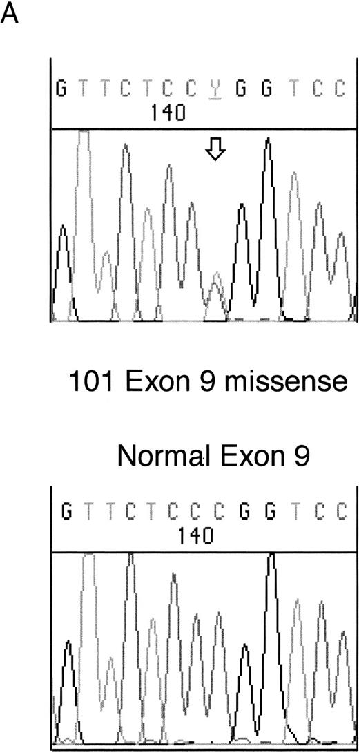 Fig. 1. Sequencing of WT1 mutations in leukemias. (A) An example of a heterozygous point mutation (arrow). (B) An example of a heterozygous frameshift mutation in exon 7. The open arrow marks the beginning of the insertion and the shaded arrow indicates the position of the polymorphism.