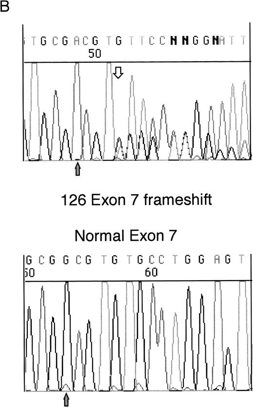 Fig. 1. Sequencing of WT1 mutations in leukemias. (A) An example of a heterozygous point mutation (arrow). (B) An example of a heterozygous frameshift mutation in exon 7. The open arrow marks the beginning of the insertion and the shaded arrow indicates the position of the polymorphism.