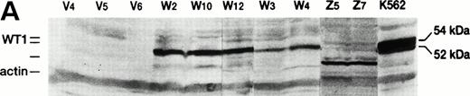 Fig. 2. WT1 expression in WT1-infected 32D clones. (A) Western blot analysis of WT1 protein. V4, V5, and V6 , empty vector-infected-32D clones; W2 , W3 , W4 , W10, and W12, wild-type WT1-infected 32D clones; Z5 and Z7, mutant WT1-infected 32D clones. (B) RT-PCR analysis of WT1 transcript. RT-PCR was performed as described previously.9 WT1 PCR products were digested with a restriction enzyme HaeIII and electrophoresed on a 1.5% agarose gel. Lane 1, K562 (a human leukemia cell line); lane 2, digestion of 1; lane 3, mouse kidney cells; lane 4, digestion of 3; lane 5, a WT1-infected 32D clone (W2); lane 6, digestion of 5; lane 7, an empty vector-infected 32D clone (V4).